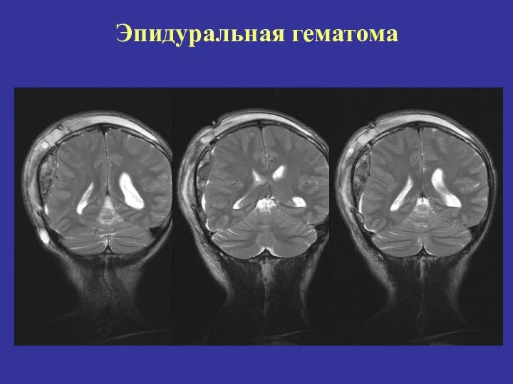 Эпидуральная гематома