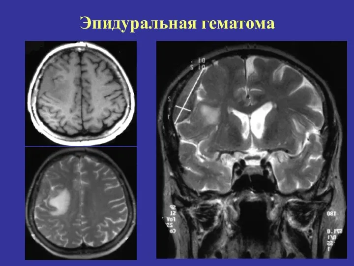 Эпидуральная гематома