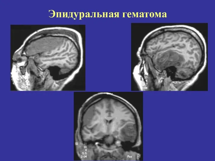 Эпидуральная гематома