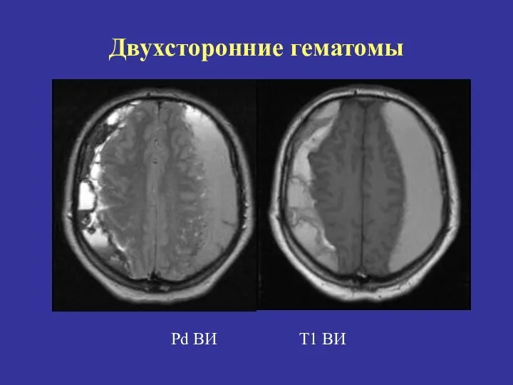 Двухсторонние гематомы Pd ВИ Т1 ВИ