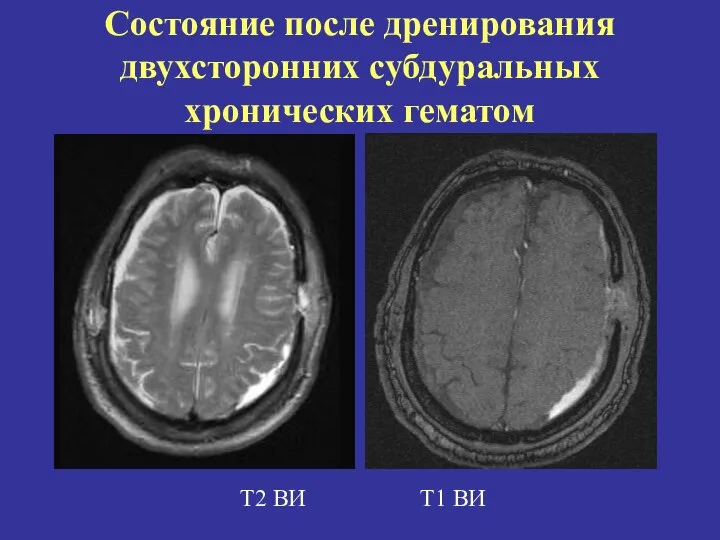 Состояние после дренирования двухсторонних субдуральных хронических гематом Т2 ВИ Т1 ВИ