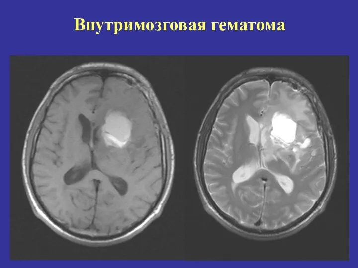 Внутримозговая гематома