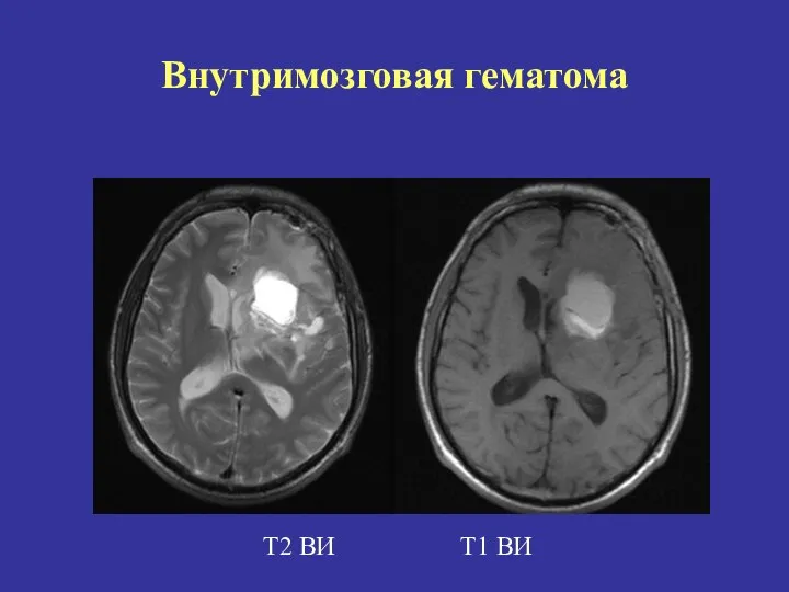 Т2 ВИ Т1 ВИ Внутримозговая гематома