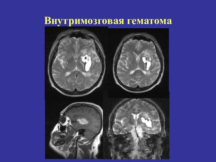 Внутримозговая гематома