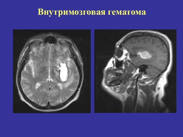 Внутримозговая гематома