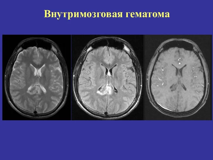 Внутримозговая гематома