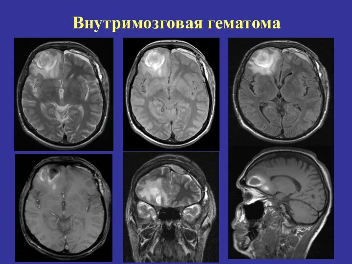 Внутримозговая гематома