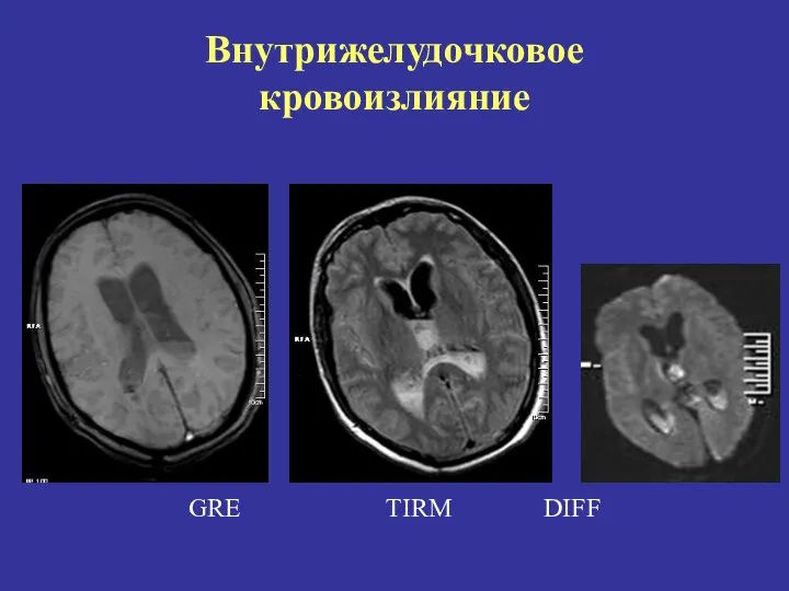 Внутрижелудочковое кровоизлияние GRE ТIRM DIFF