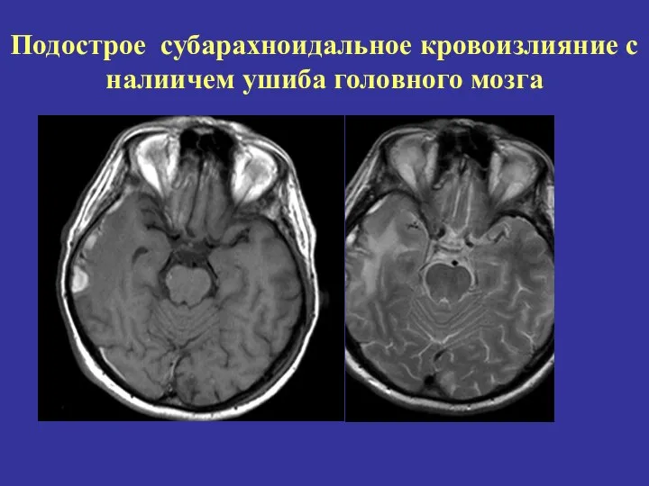 Подострое субарахноидальное кровоизлияние с налиичем ушиба головного мозга