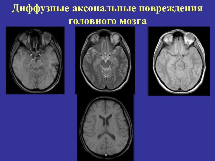 Диффузные аксональные повреждения головного мозга