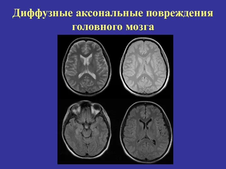 Диффузные аксональные повреждения головного мозга