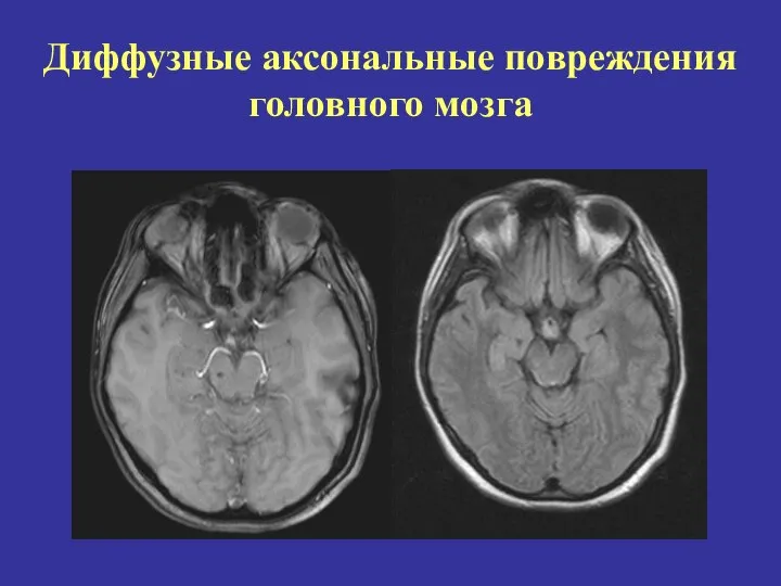 Диффузные аксональные повреждения головного мозга