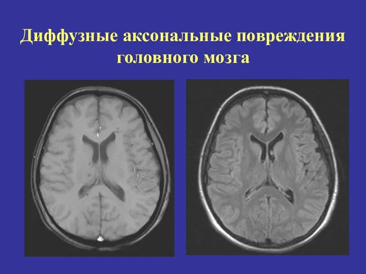 Диффузные аксональные повреждения головного мозга