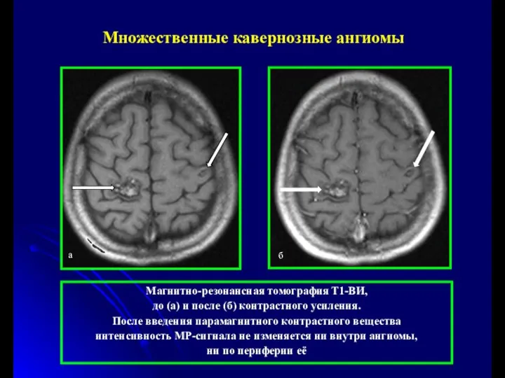 Магнитно-резонансная томография Т1-ВИ, до (а) и после (б) контрастного усиления. После