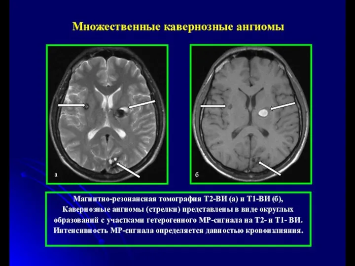 Магнитно-резонансная томография Т2-ВИ (а) и Т1-ВИ (б), Кавернозные ангиомы (стрелки) представлены