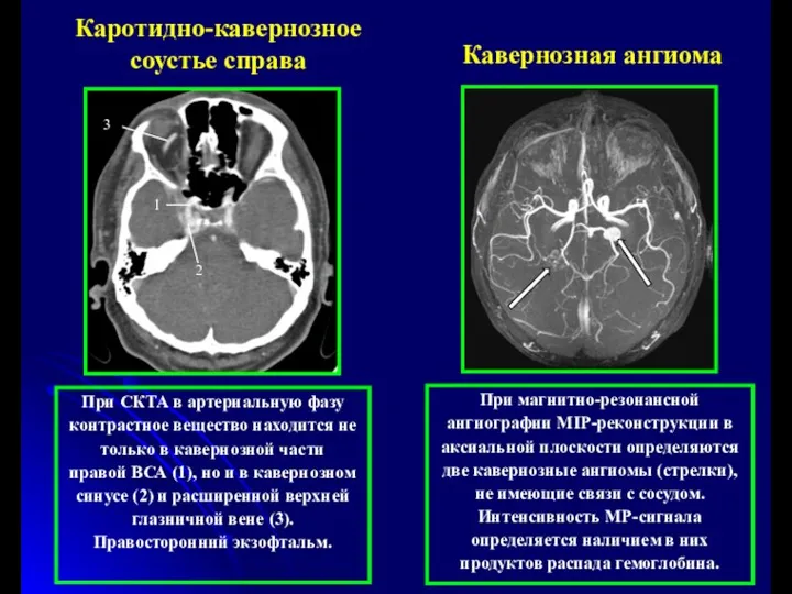 При магнитно-резонансной ангиографии MIP-реконструкции в аксиальной плоскости определяются две кавернозные ангиомы