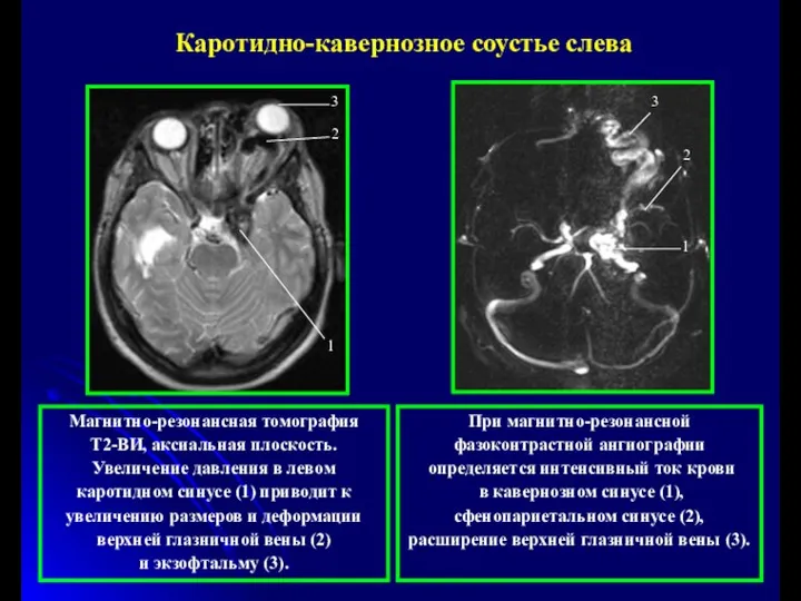 При магнитно-резонансной фазоконтрастной ангиографии определяется интенсивный ток крови в кавернозном синусе