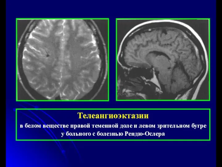 Телеангиоэктазии в белом веществе правой теменной доле и левом зрительном бугре у больного с болезнью Рендю-Ослера