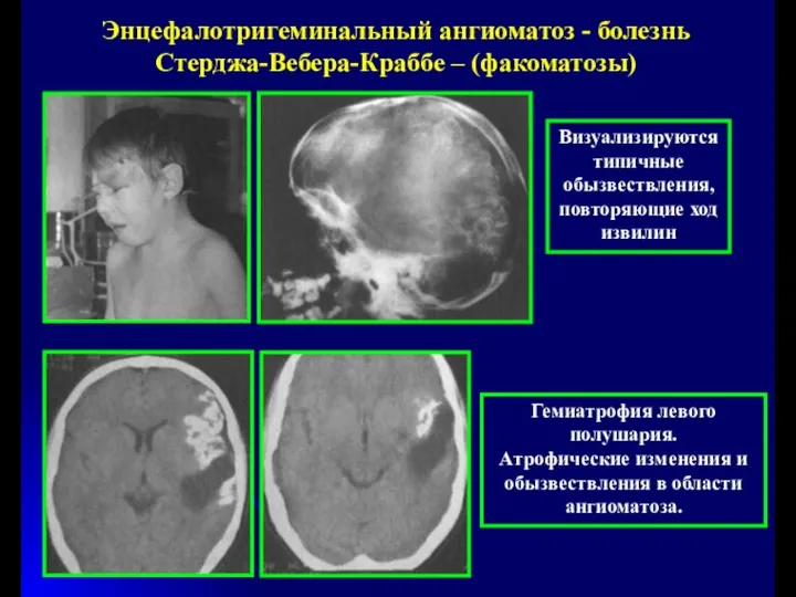 Энцефалотригеминальный ангиоматоз - болезнь Стерджа-Вебера-Краббе – (факоматозы) Гемиатрофия левого полушария. Атрофические