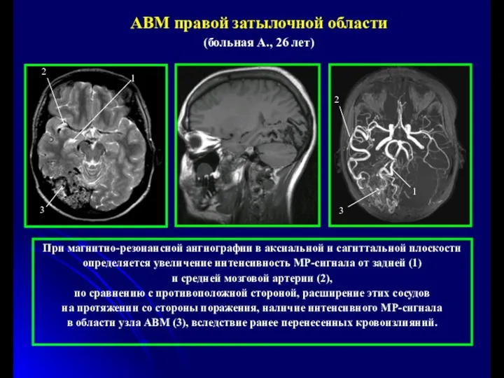 При магнитно-резонансной ангиографии в аксиальной и сагиттальной плоскости определяется увеличение интенсивность