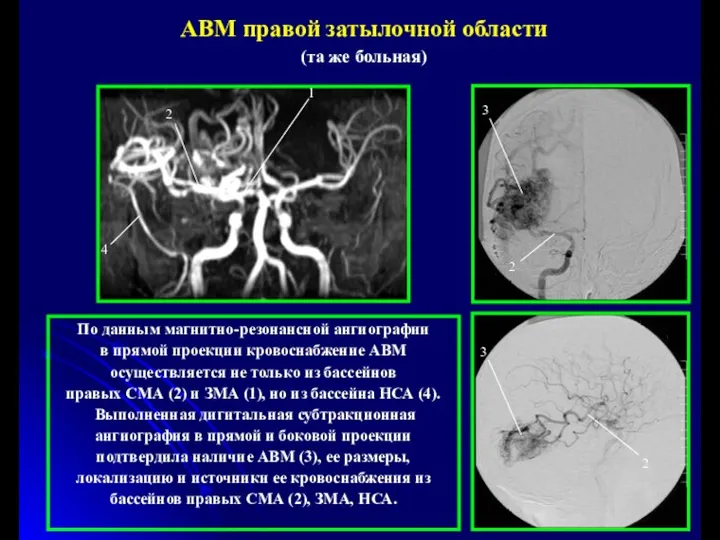 АВМ правой затылочной области (та же больная) По данным магнитно-резонансной ангиографии