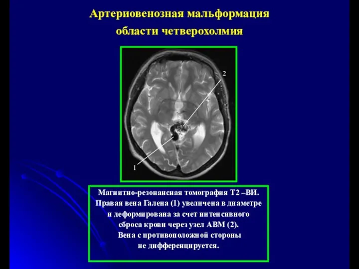 Магнитно-резонансная томография Т2 –ВИ. Правая вена Галена (1) увеличена в диаметре