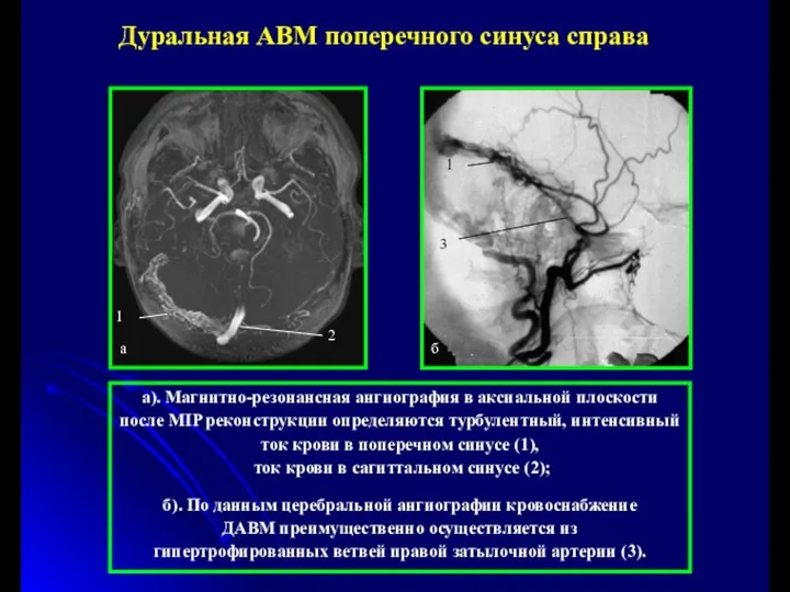 а). Магнитно-резонансная ангиография в аксиальной плоскости после MIP реконструкции определяются турбулентный,