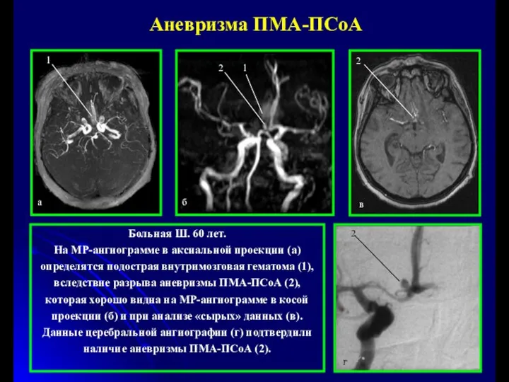Больная Ш. 60 лет. На МР-ангиограмме в аксиальной проекции (а) определятся