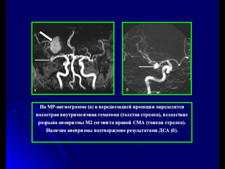 На МР-ангиограмме (а) в переднезадней проекции определятся подострая внутримозговая гематома (толстая