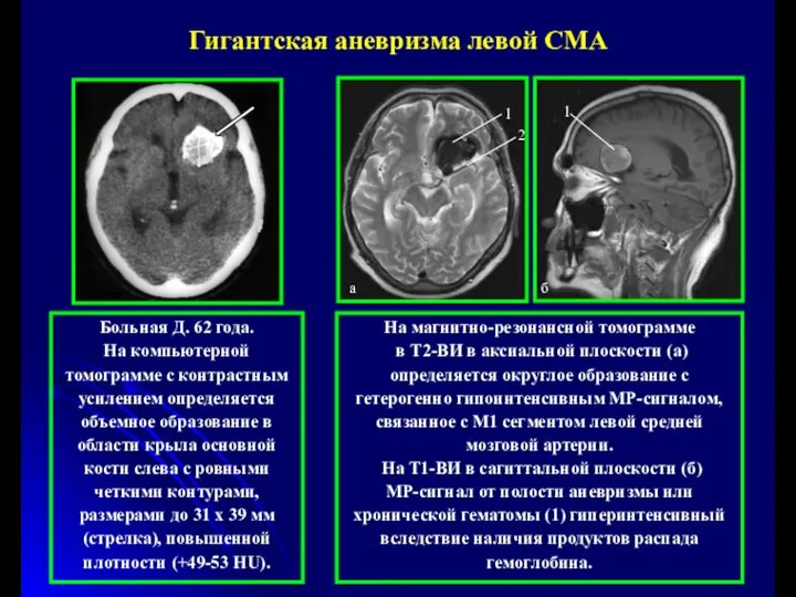 Больная Д. 62 года. На компьютерной томограмме с контрастным усилением определяется