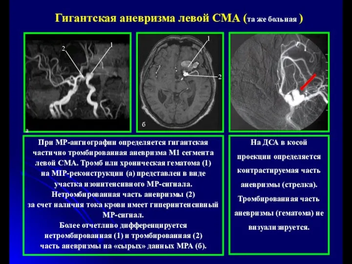 При МР-ангиографии определяется гигантская частично тромбированная аневризма М1 сегмента левой СМА.
