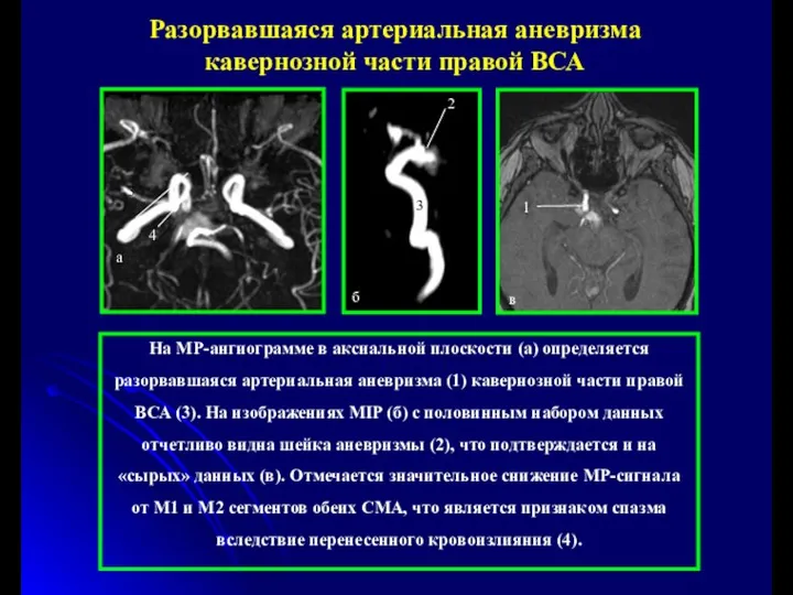 3 На МР-ангиограмме в аксиальной плоскости (а) определяется разорвавшаяся артериальная аневризма