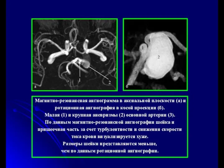 Магнитно-резонансная ангиограмма в аксиальной плоскости (а) и ротационная ангиография в косой