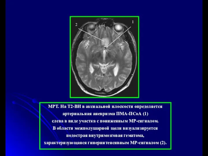 МРТ. На Т2-ВИ в аксиальной плоскости определяется артериальная аневризма ПМА-ПСоА (1)