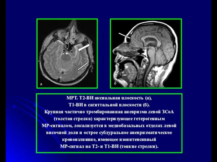 МРТ. Т2-ВИ аксиальная плоскость (а), Т1-ВИ в сагиттальной плоскости (б). Крупная