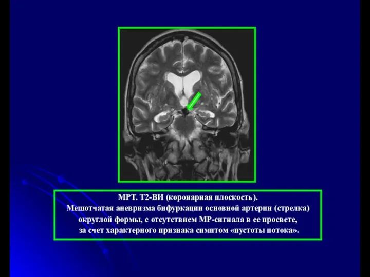 МРТ. Т2-ВИ (коронарная плоскость). Мешотчатая аневризма бифуркации основной артерии (стрелка) округлой