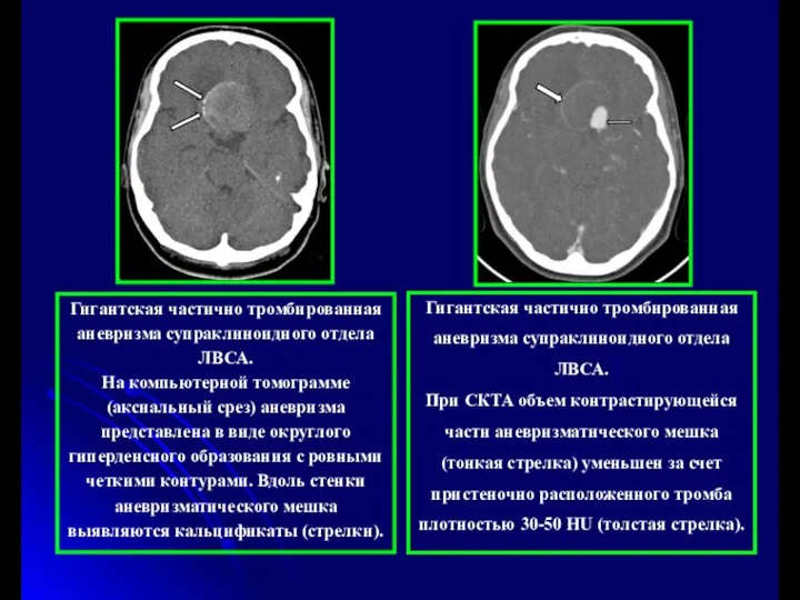 Гигантская частично тромбированная аневризма супраклиноидного отдела ЛВСА. На компьютерной томограмме (аксиальный