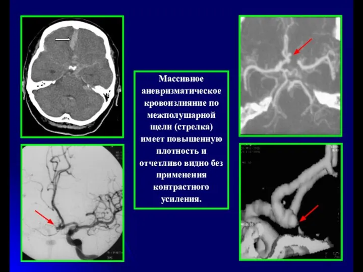 Массивное аневризматическое кровоизлияние по межполушарной щели (стрелка) имеет повышенную плотность и
