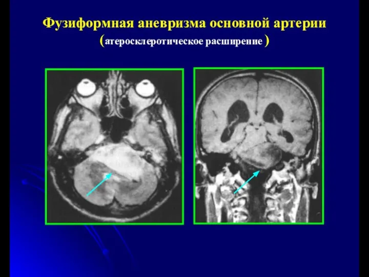 Фузиформная аневризма основной артерии (атеросклеротическое расширение )