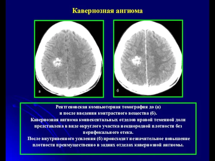 Рентгеновская компьютерная томография до (а) и после введения контрастного вещества (б).