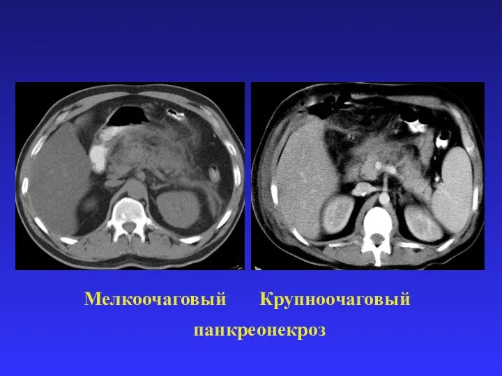 Мелкоочаговый Крупноочаговый панкреонекроз