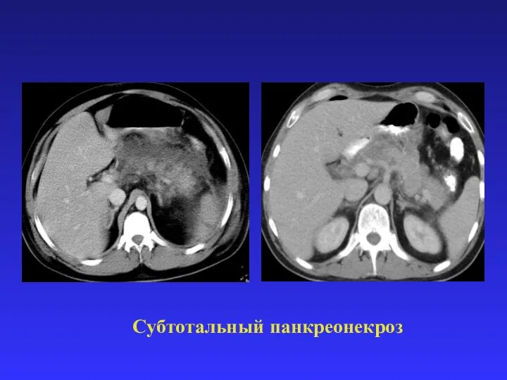 Субтотальный панкреонекроз