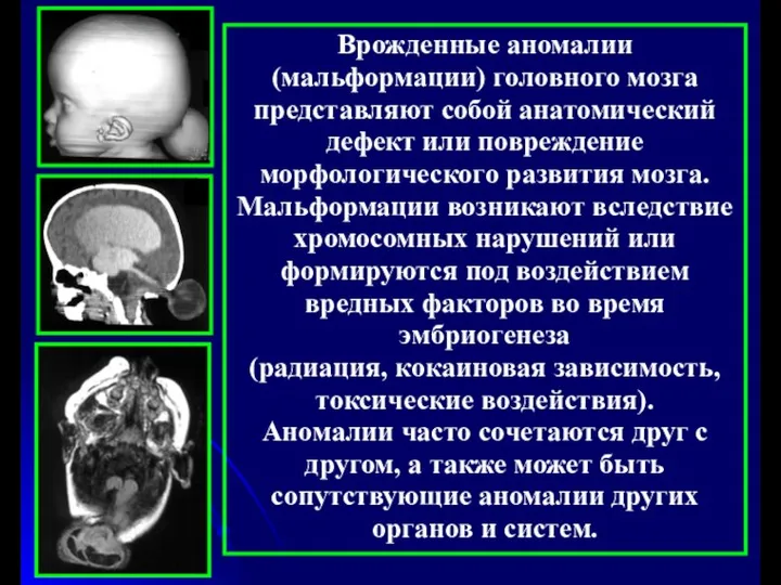 Врожденные аномалии (мальформации) головного мозга представляют собой анатомический дефект или повреждение