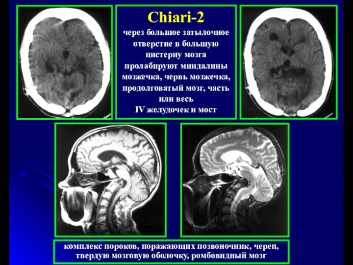 Chiari-2 через большое затылочное отверстие в большую цистерну мозга пролабируют миндалины