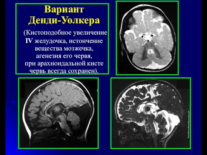 Вариант Денди-Уолкера (Кистоподобное увеличение IV желудочка, истончение вещества мозжечка, агенезия его