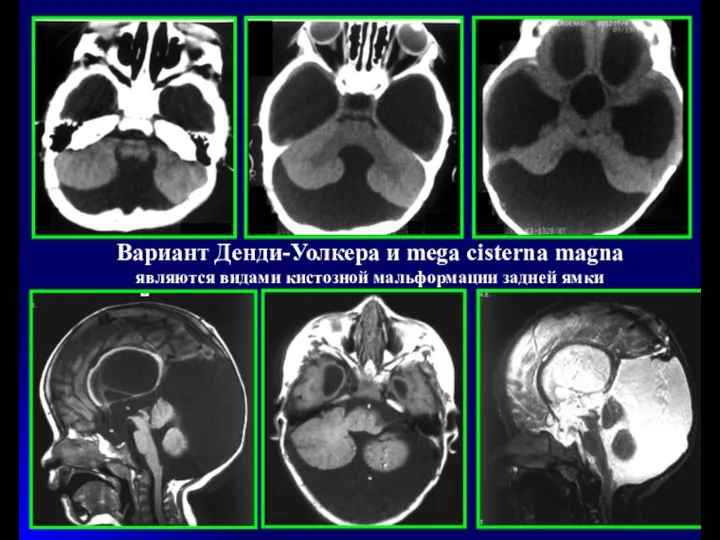 Вариант Денди-Уолкера и mega cisterna magna являются видами кистозной мальформации задней ямки