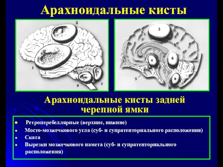 Арахноидальные кисты Арахноидальные кисты задней черепной ямки Ретроцеребеллярные (верхние, нижние) Мосто-мозжечкового