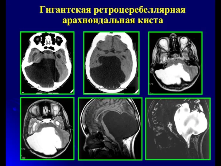 Гигантская ретроцеребеллярная арахноидальная киста