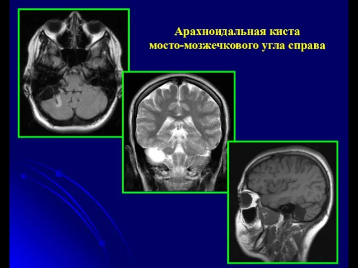 Арахноидальная киста мосто-мозжечкового угла справа