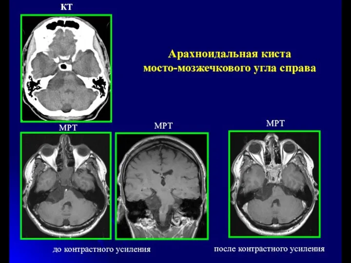 до контрастного усиления после контрастного усиления Арахноидальная киста мосто-мозжечкового угла справа КТ МРТ МРТ МРТ